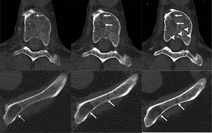 Novel Photon-Counting CT Improves Myeloma Bone Disease Detection