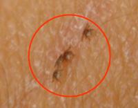 Larval Ticks