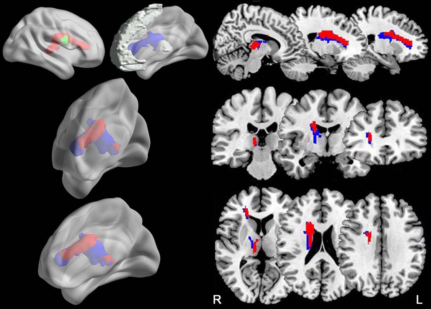 Images of Stroke Lesions (2 of 2)