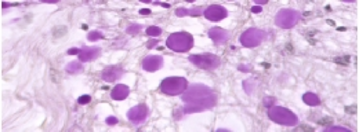 Researchers identify a new marker related to the dysfunction of the glymphatic system