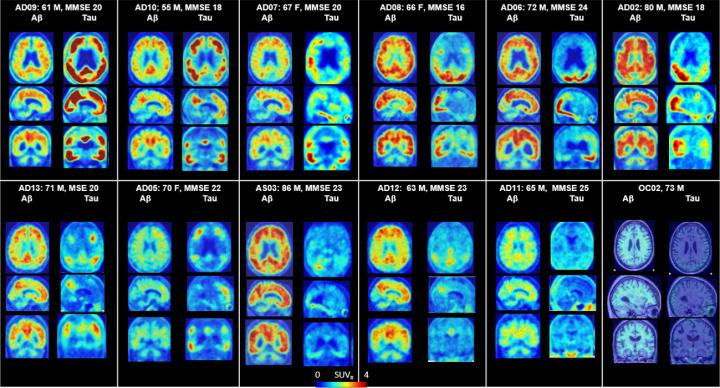 PET Scans of the Brains of Alzheimer's Patients