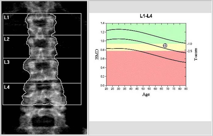 Bone density scan (DEXA scan)