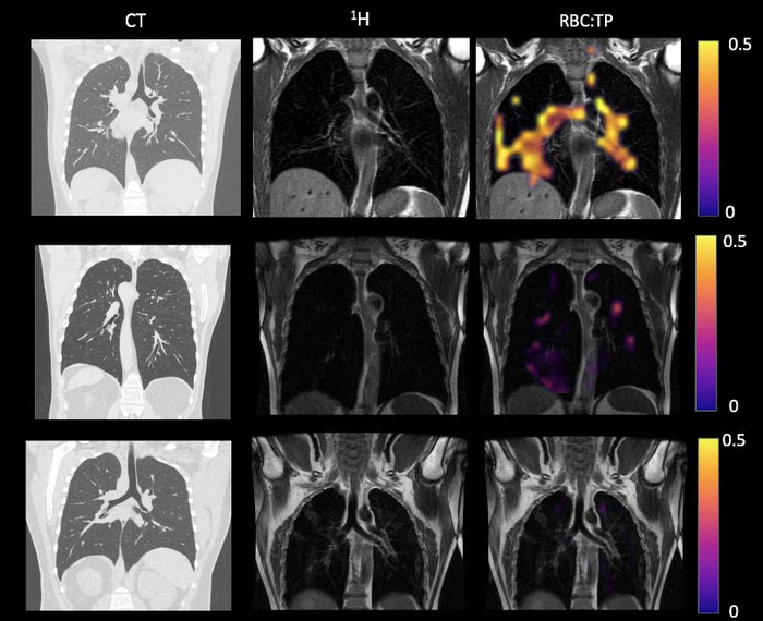 MRI Finds Lung Abnormalities in Non-Hospitalized Long COVID Patients