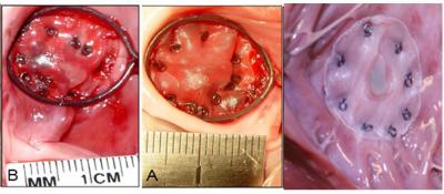 Beating-Heart Repair of Atrial Septal Defects