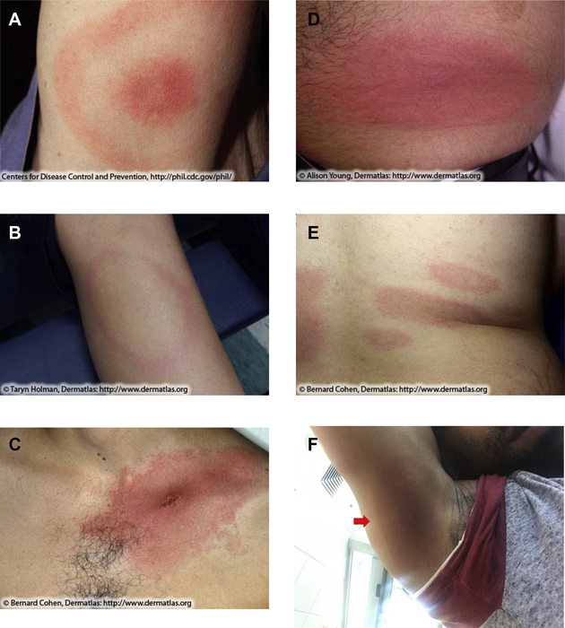 Erythema migrans