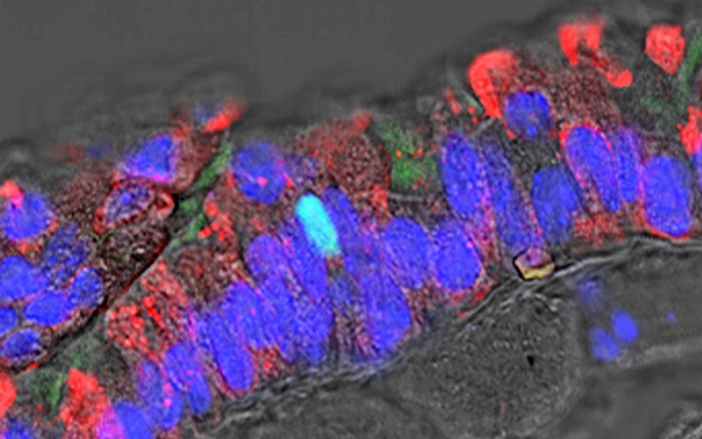 Identifying the Culprint in New Type of Lung Cancer