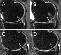 MRIs of the Right Knee
