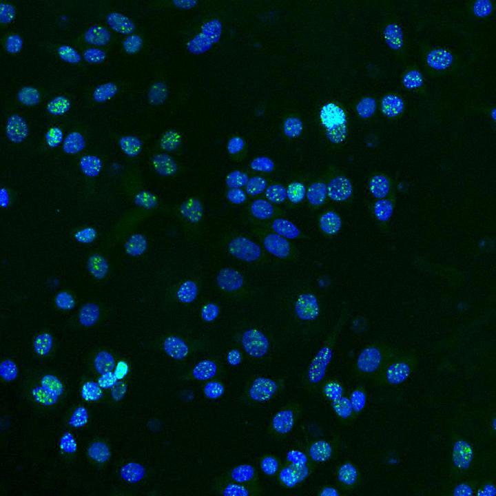 DNA Damage Accumulated by Breast Cancer Cells