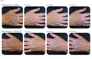 A Comparative Study of Two Topical Treatments for Photoaging of the Hands