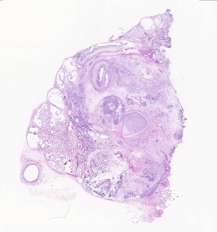 Teratoma histology