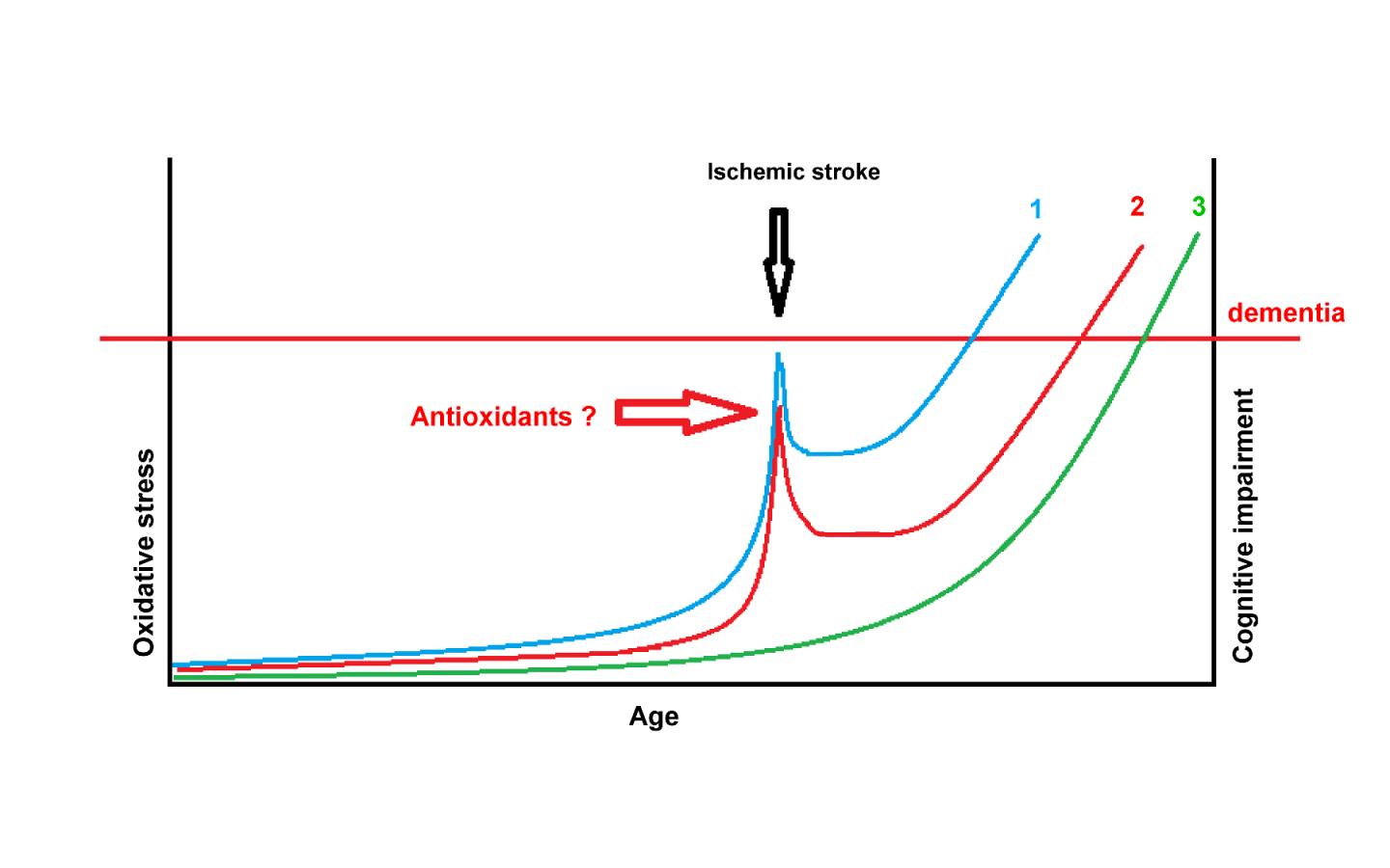 Antioxidant treatment in acute ischemic stroke may delay the onset of Alzheimer's dementia