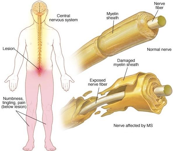 Myelin Damage in Multiple Sclerosis. Image Courtesy of Mayo Clinic