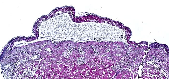 Toxic Epidermal Necrolysis