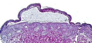 Toxic Epidermal Necrolysis