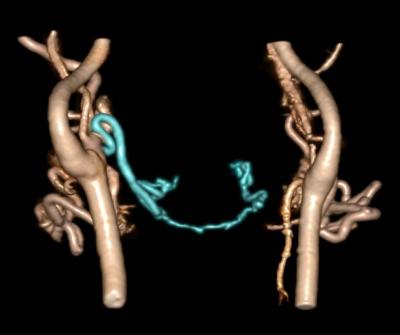 CT Angiography after Face Transplantation