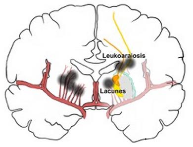 Brain CSVD