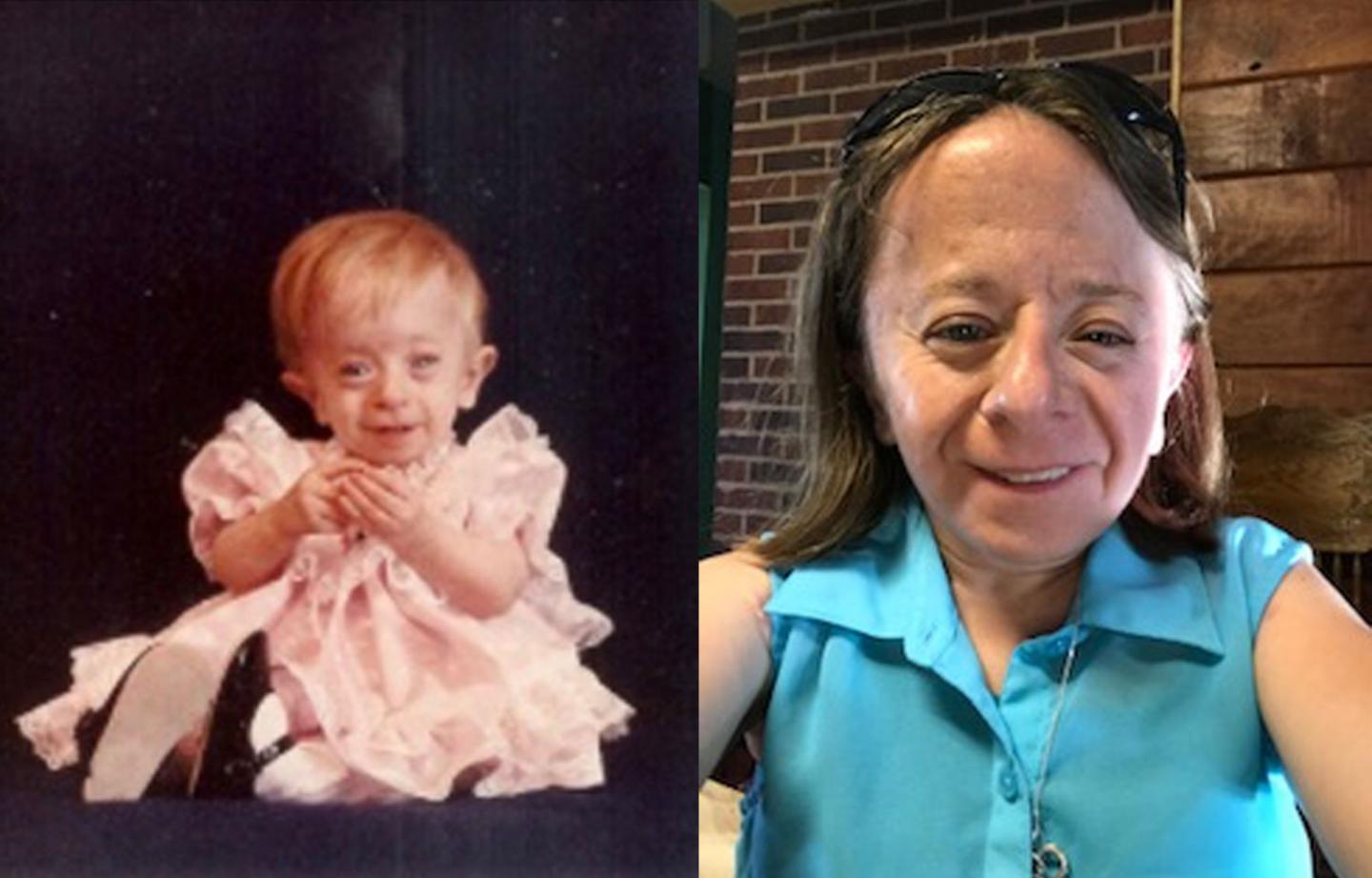 Monica Zaring, Who Has Saul-Wilson Syndrome, as a Child and Today