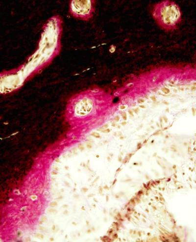 Skeletal Abnormalities in Neurofibromatosis