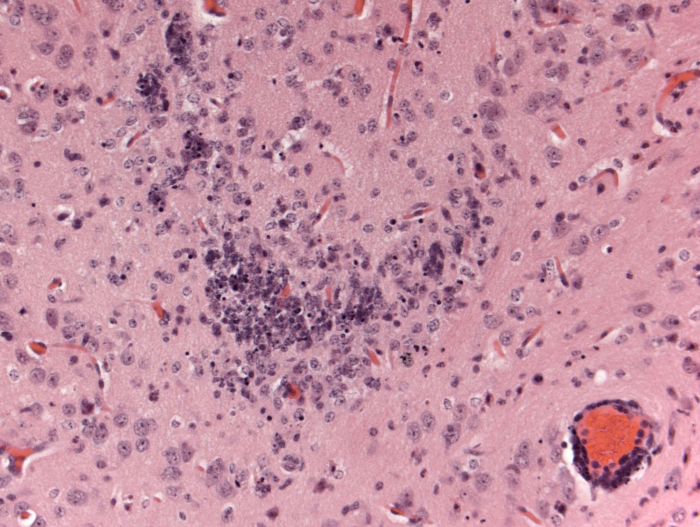 Diffusely Scattered Nuclear Degeneration