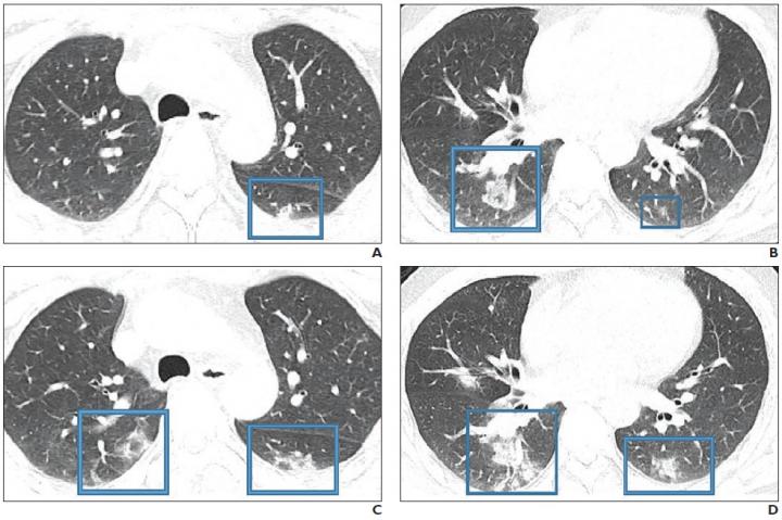47-Year-Old Chinese Man With 2-Day History Of Fever, Chills, Productive Cough, Sneezing, Fatigue