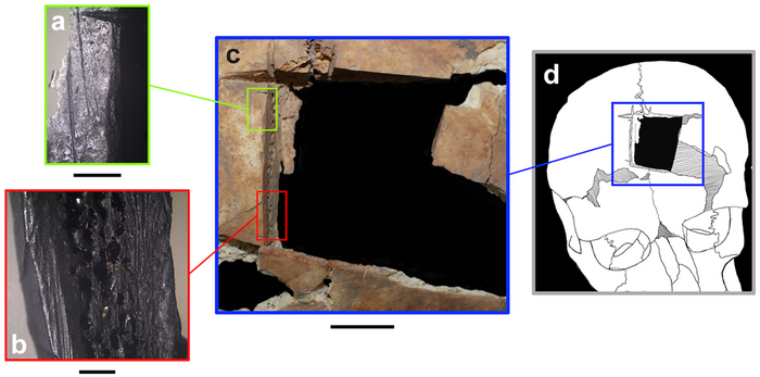 Cranial trephination and infectious disease in the Eastern Mediterranean: The evidence from two elite brothers from Late Bronze Megiddo, Israel