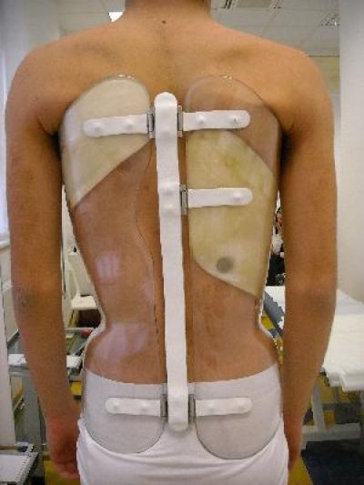 Innovative scoliosis treatment: A back brace