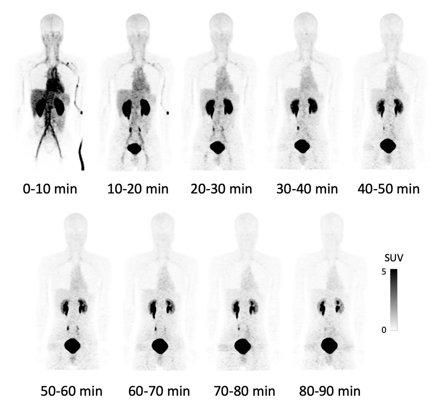 Normal Pet Scan Images