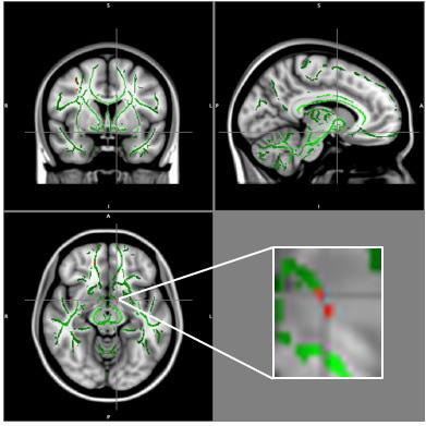 Brain's Appetite Regulator Disrupted in Obese Teens