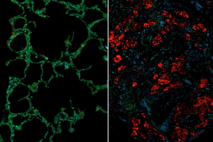 Normal lung vs. scleroderma lung