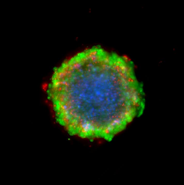 Representative Image of 3D Model of Colorectal Carcinoma