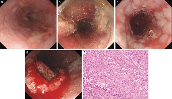 Histopathological analysis confirmed the presence of esophageal squamous cell carcinoma