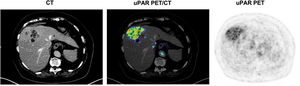 uPAR Positive Liver Metastasis