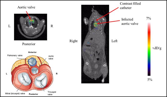 6 inch-[<sup>18</sup>F]Fluoromaltotriose, a New PET Imaging Agent that Visualizes Valvular Infection