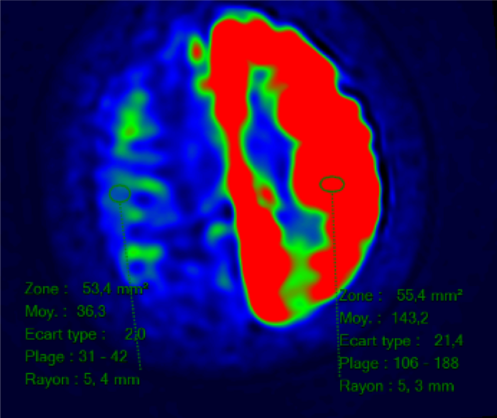 Paralysis on one side of the brain