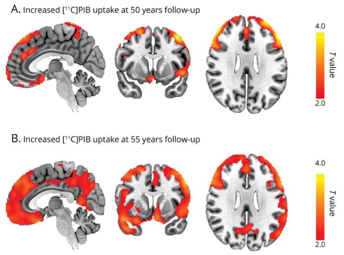 Increased amyloid accumulation in individuals with childhood-onset epilepsy.