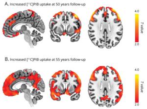 Increased amyloid accumulation in individuals with childhood-onset epilepsy.