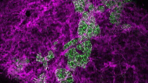 Pancreatic Cancer Cells