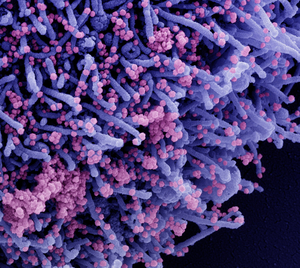 SEM image of human cell infected with SARS-CoV-2