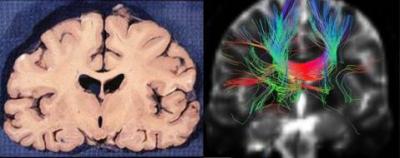 Coronal Anatomy and Fiber Tracking