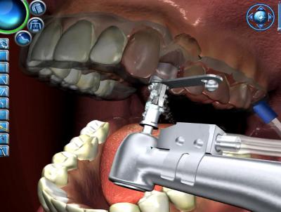 Virtual Dental Implant Training Simulation Program (1 of 2)