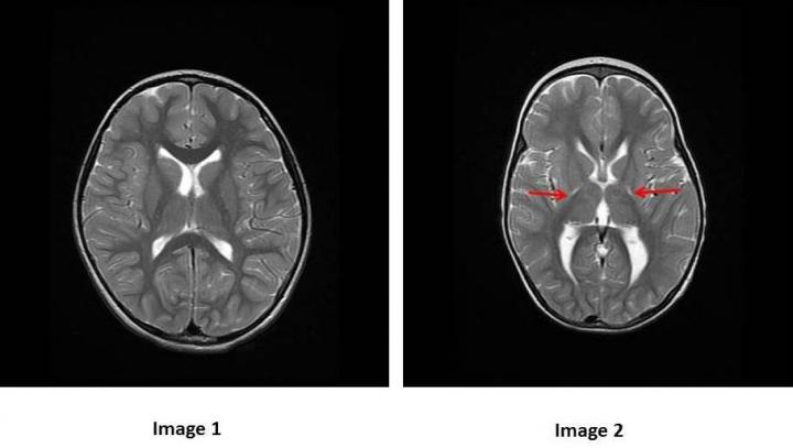 MRI of the Brain of a Healthy Child vs. MRI of the Brain of a Child with Cerebral Palsy