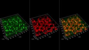 Human breast cancer cells are seen migrating within a 3D model