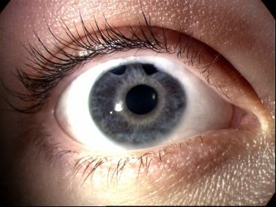 Pediatric Glaucoma Patient