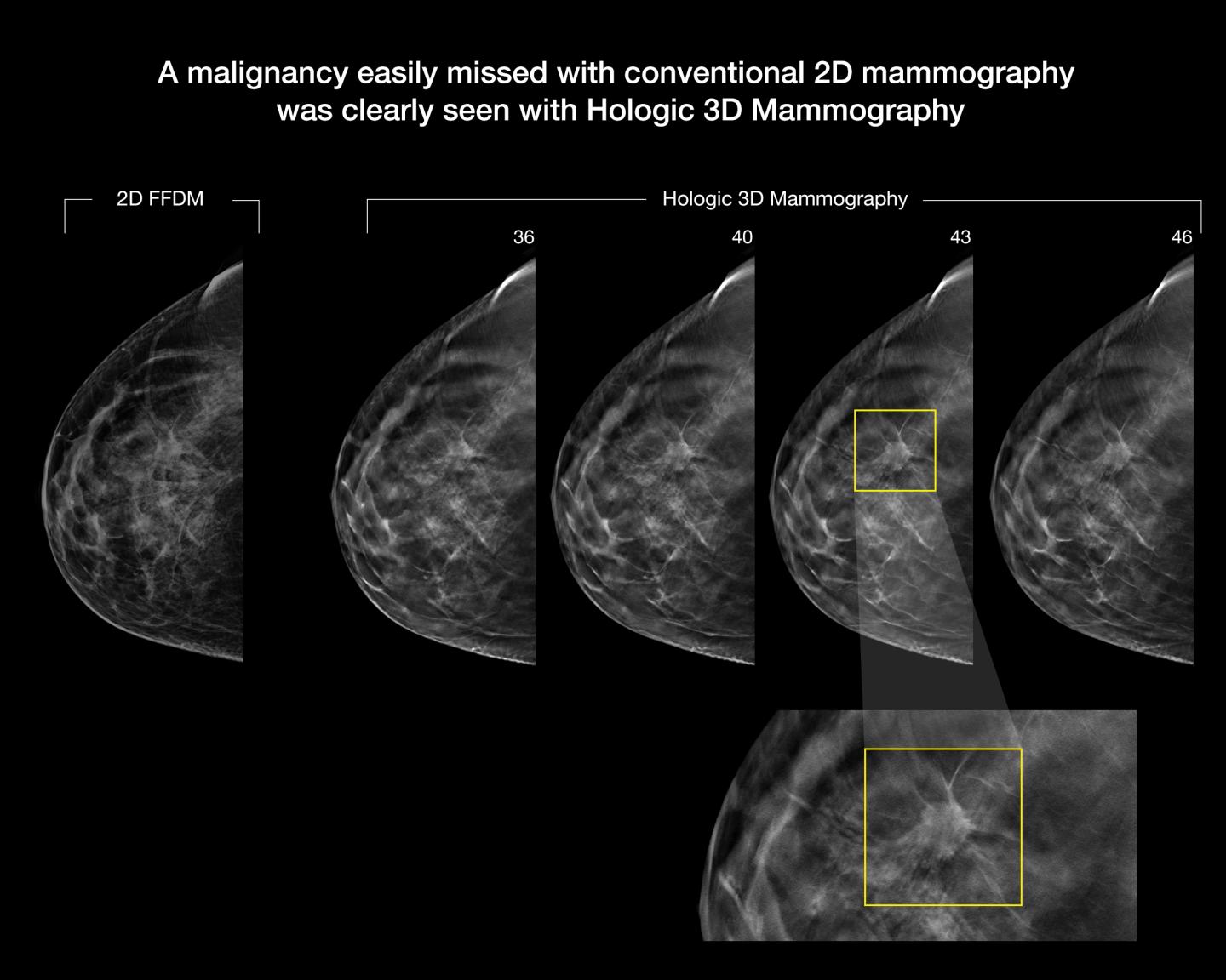 Mammography Comparison