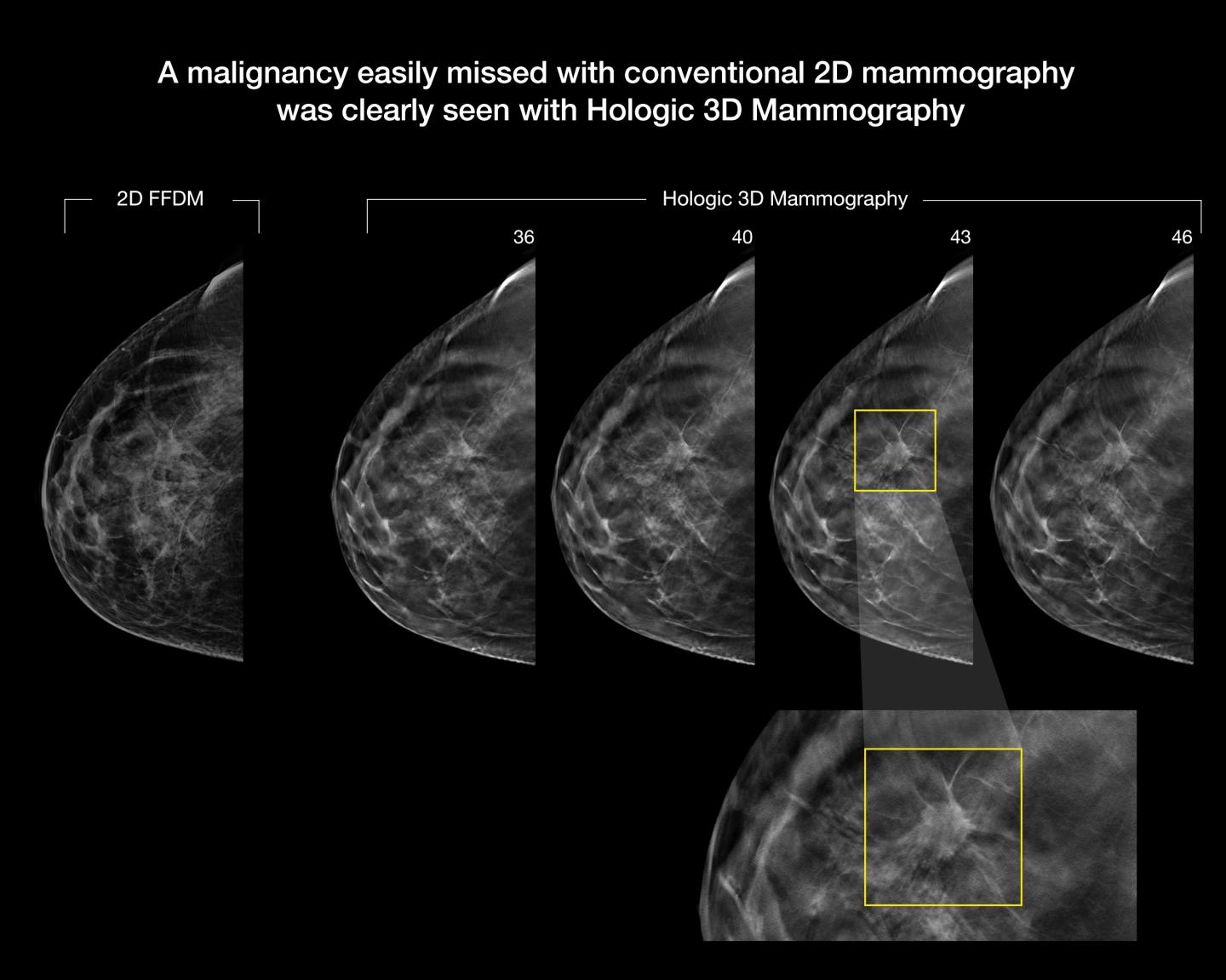 Can a Radiologist Diagnose Breast Cancer from Imaging Tests Alone?