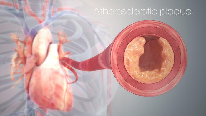 Atherosclerosis is a cardiac disease trending upward with high mortality