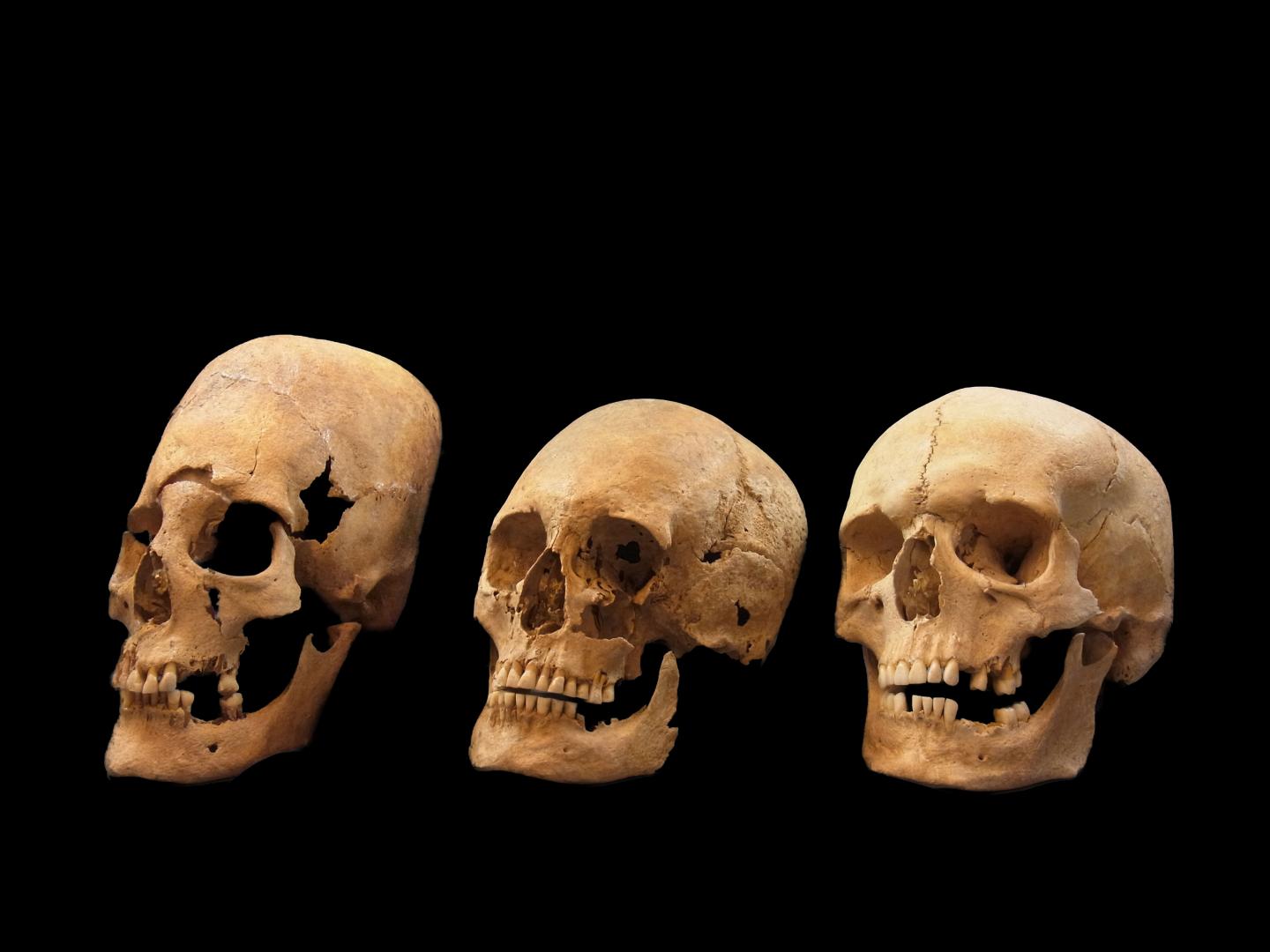 A Deformed, Intermediate, and Non-deformed Human Skull