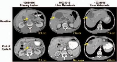 Trial Results Hint at Therapies for Pancreatic Cancer (2 of 3)