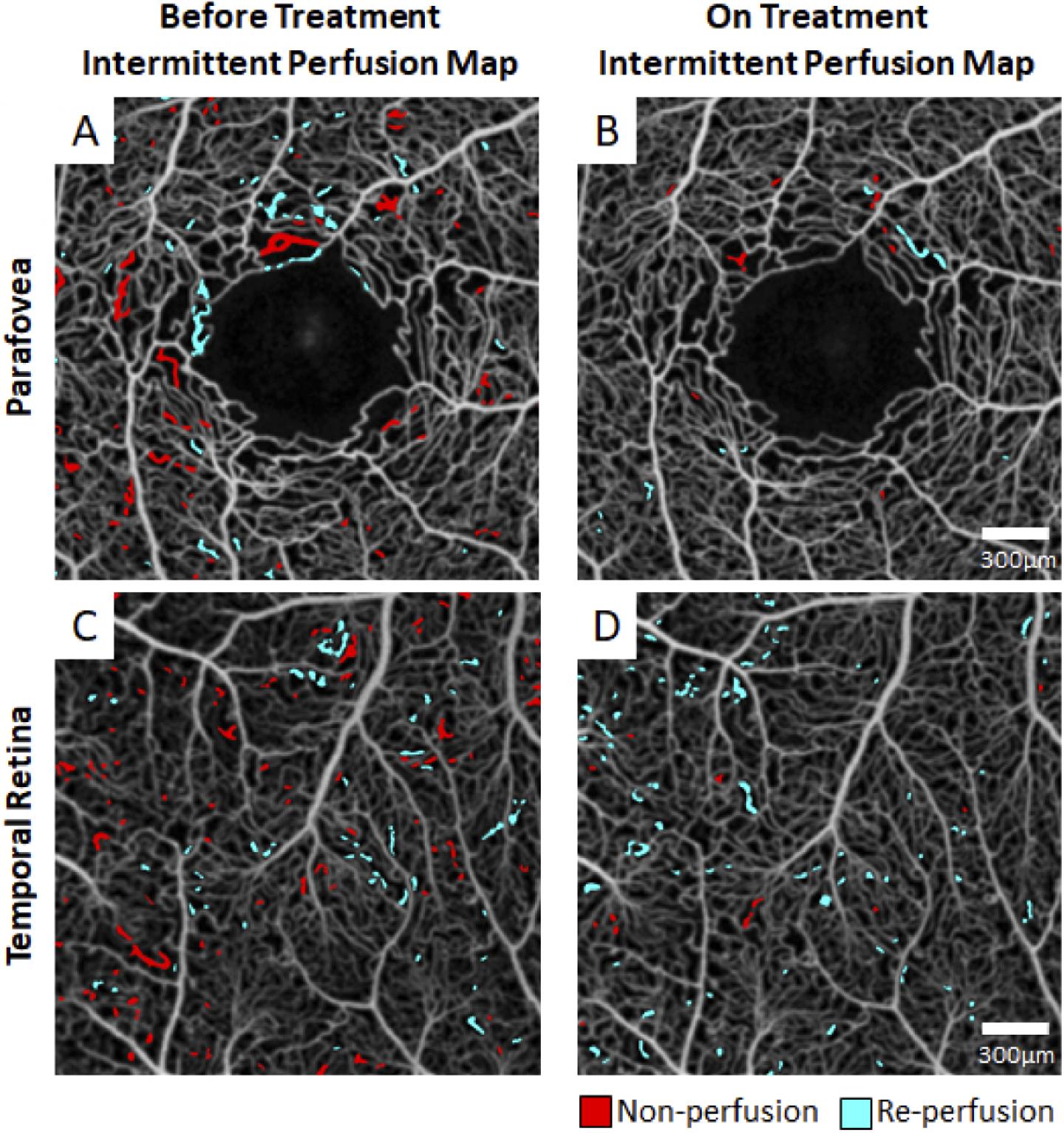 Perfusion Maps Before Treatment And On Treatment