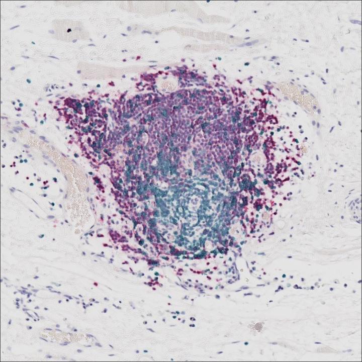 Tertiary Lymphoid Structures